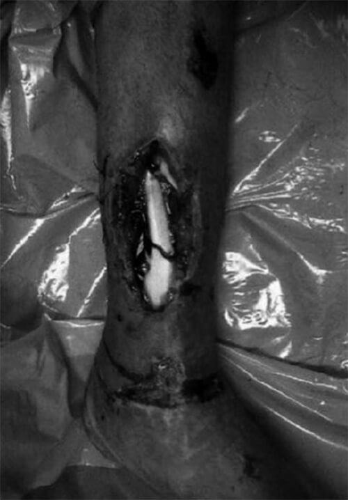 Figura 2. Foto clínica donde se evidencia el defecto cutáneo y el segmento óseo expuesto