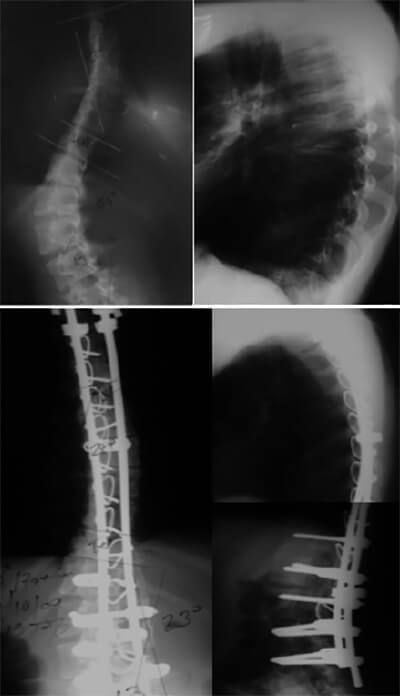 Imagen N° 2: Caso de EIA tratado mediante artrodesis instrumentada posterior con sistema híbrido ISOLA.