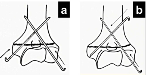Figura 1. Técnicas quirúrgicas evaluadas: Cruzada o “Banderillero” (a) y Dorgan (b)
