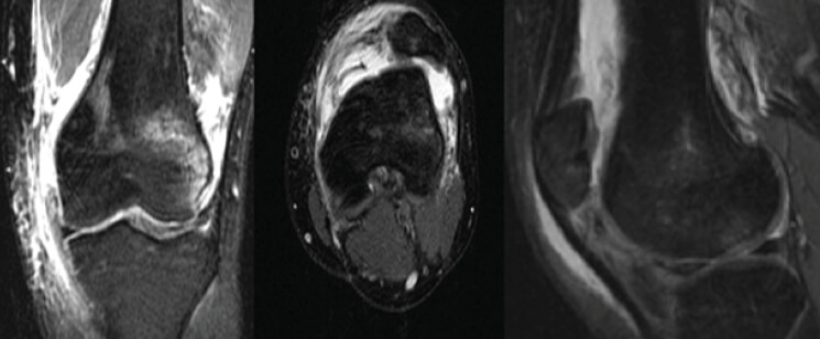 Figura 1. Resonancia magnética de rodilla izquierda donde se defectó condral >15mm en cóndilos femorales