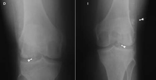 Figura nº 1. Radiografía simple de ambas rodillas con apoyo, proyecciones
anteroposteriores. Flechas indican calcificaciones ovaladas.