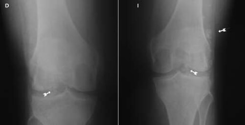 Figura nº 1. Radiografía simple de ambas rodillas con apoyo, proyecciones
anteroposteriores. Flechas indican calcificaciones ovaladas.