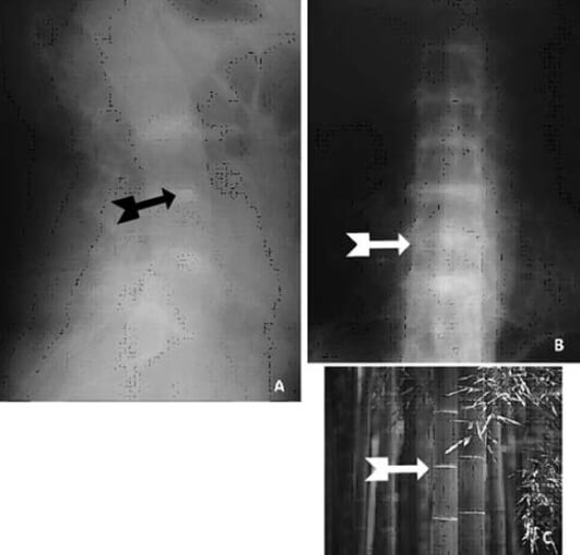Figura nº 9. Radiografía simple de: A) Columna lumbo sacra proyección lateral. B) Columna dorso lumbar proyección anteroposterior. Flechas indican calcificación de los núcleos pulposos y signo de palo de bambú. C) Imagen comparativa.