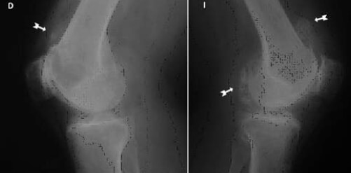 Radiografía simple de ambas rodillas, proyecciones laterales.
Flechas indican calcificaciones ovaladas.