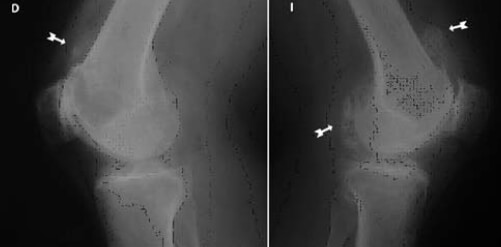 Radiografía simple de ambas rodillas, proyecciones laterales.
Flechas indican calcificaciones ovaladas.