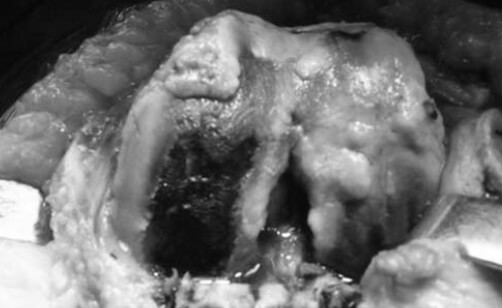 Figura nº 2. Superficie articular del fémur distal.