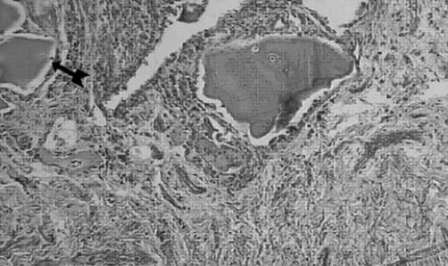 Figura nº 5. Corte histológico de cartílago articular a mayor aumento. La flecha
muestra en mayor detalle las lagunas ocronoticas.