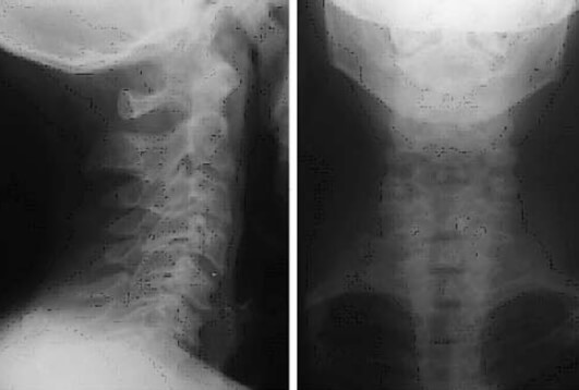 Figura nº 8. Radiografía simple de columna cervical, proyecciones anteroposterior y lateral.
