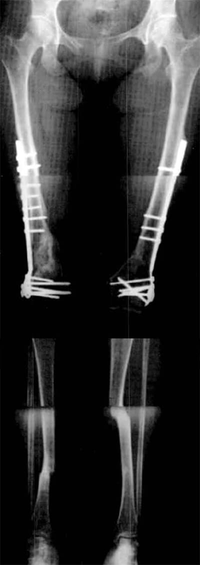 Figura N° 1 Radiografías anteroposteriores correspondientes al único caso (0,31 %) de RF bilateral encontrado. A 7 años del traumatismo.
