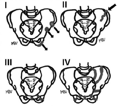 Figura Nº 1. Clasificación de Torode y Zieg(16).