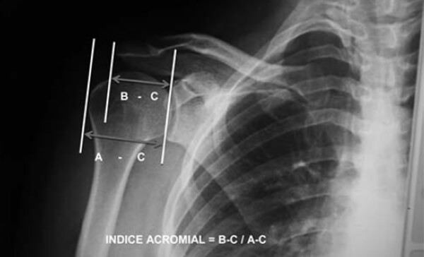 Figura N° 1. Medición del índice Acromial