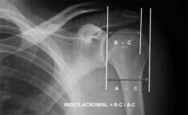 Figura N° 2. Medición del índice Acromial