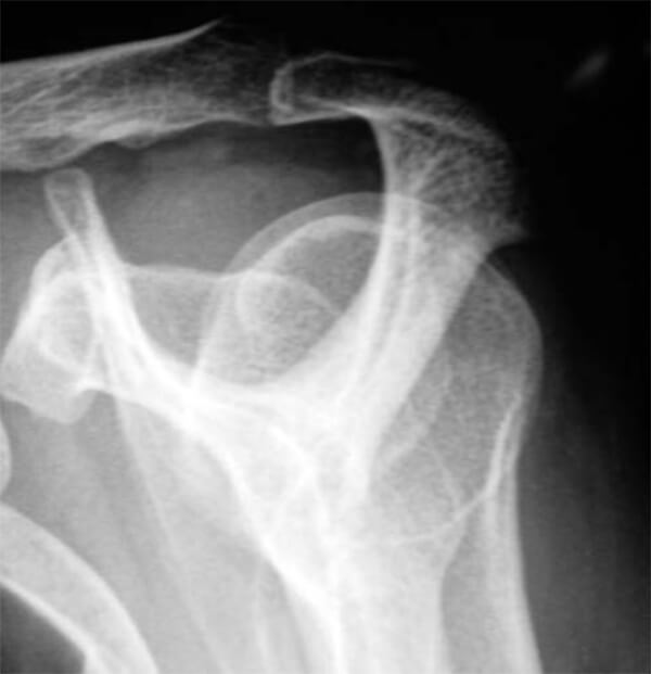 Figura N° 3. Determinación de la morfología acromial