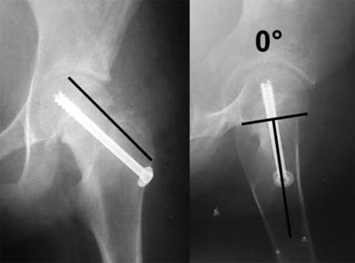 Radiografías anteroposterior (izquierda) y de Lowenstein (derecha).
Se evidencia la corrección en ambos planos, en relación a la línea de
Klein y el ángulo de desprendimiento.