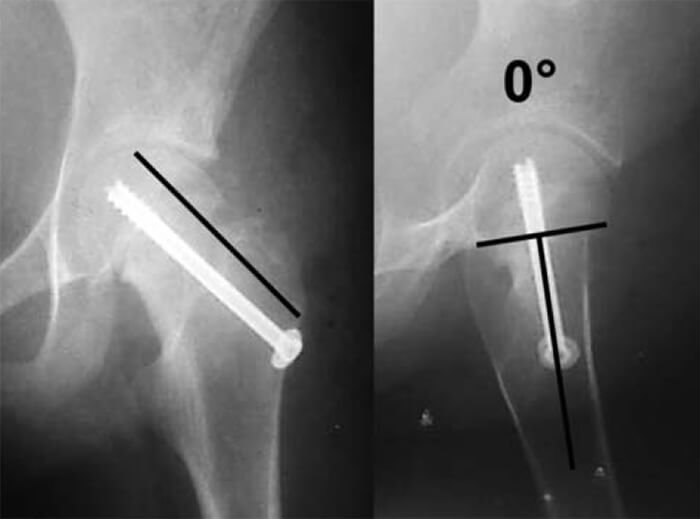 Radiografías anteroposterior (izquierda) y de Lowenstein (derecha).
Se evidencia la corrección en ambos planos, en relación a la línea de
Klein y el ángulo de desprendimiento.