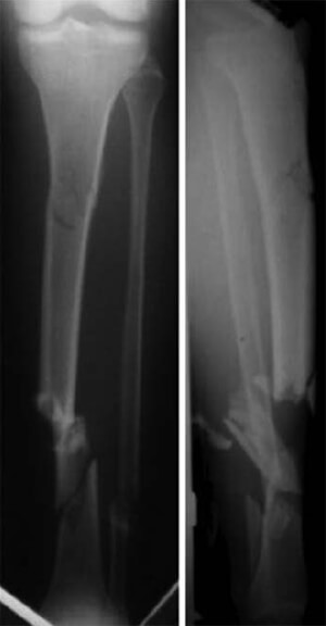 Figura N° 1. Radiografía panorámica anteroposterior y lateral de la tibia izquierda