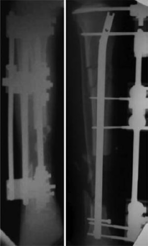 Figura N° 4. Radiografías panorámicas de la tibia en el post operatorio inmediato