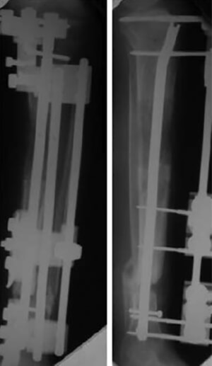 Figura N° 5. Radiografías panorámicas de la tibia al término del transporte (77 días).