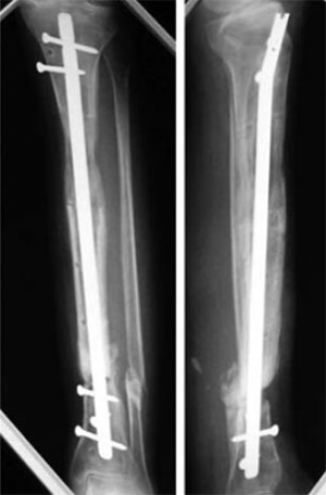 Figura N° 7. Radiografías panorámicas de la tibia después del retiro del transportador