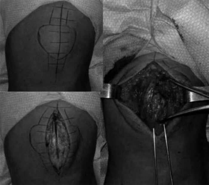 Figura 3. Técnica quirúrgica. Fotos del intraoperatorio.