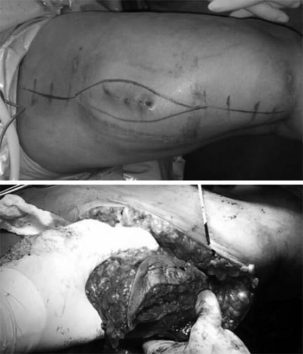 Figura N° 4. Fotos clínicas del intraoperatorio.