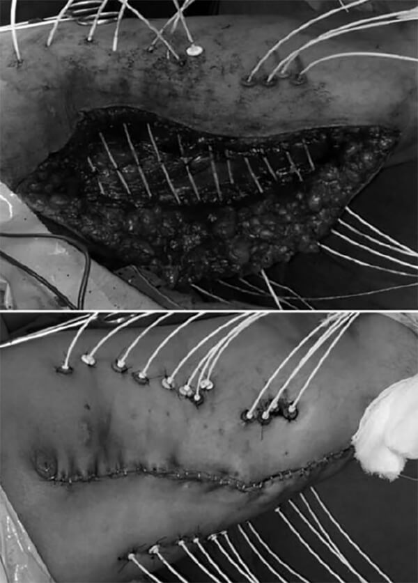 Figura N° 6. Fotos clínicas del intraoperatorio, tras la colocación de los 12 catéteres de braquioterapia.