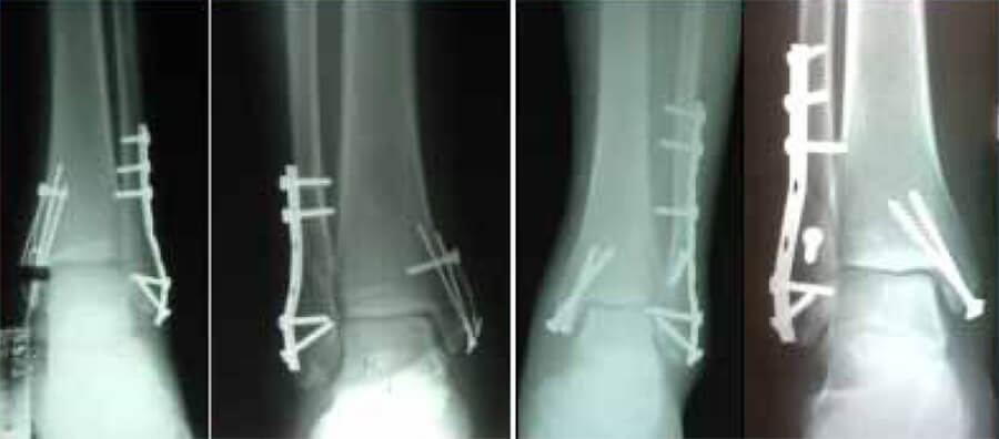 Fig. 01 La reducción del método medial se fijó indistintamente con cerclaje funcional (izquierda), dos tornillos de esponjosa de 4.0 mm (derecha). En el caso de trazo oblicuo en peroné se coloca tornillo de compresión Interfragmentaria. La placa de 1/3 de tubo con función de compresión axial o de neutralización. No hubo diferencia en el resultado final ni la evolución.