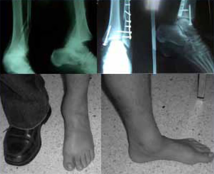 Fig. 02. Arriba izquierda: Luxo-fractura de tobillo completo (AO: 44C2). Lesiones severas con daño sindesmal y de capsula articular. Muestra dificultad para reducir el peroné, especialmente la rotación. Derecha: Síntesis con reducción deficiente, no se restablece la longitud ni rotación del peroné. Persiste claro medial. Abajo: Aspecto clínico. Paciente consulta posterior a 2 años de cirugía. Refiere dolor y edema vespertino. Tiene signos degenerativos articulares. Actualmente (6 años de evolución) paciente tiene dolor y limitación. Mal resultado en escala de evolución. Se plantea una artrodesis.