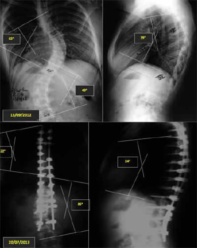 Imagen N° 1: Caso de EIA tratado mediante artrodesis instrumentada posterior con sistema de tornillos pediculares.