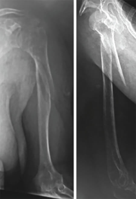 Figura 1. Radiografía anteroposterior y lateral del húmero izquierdo al momento de su ingreso.