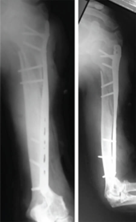 Figura 2. Radiografías panorámicas del húmero post operatorias en sus proyecciones anteroposterior y lateral.