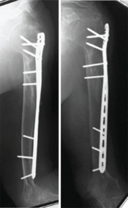 Figura 4. Radiografías panorámicas del húmero izquierdo en sus proyecciones anteroposterior y lateral a los 12 meses del post operatorio.