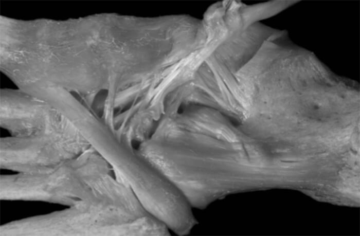 Imagen 1. Inserciones distales del tendón Tibial Posterior