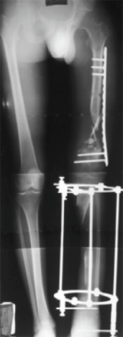 Figura 1. Fijación con placa LCP 4.5mm para fémur, tutor tipo Illizarov para tibia.