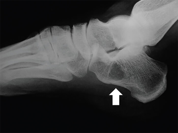Figura 1. Radiografía lateral del calcáneo derecho al momento de su ingreso. La flecha blanca señala la lesión.