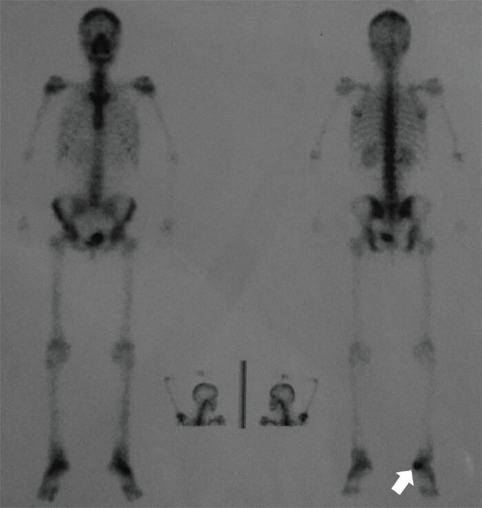 Figura 2. Imágenes de la gammagrafía ósea. La flecha blanca señala la localización de la lesión
