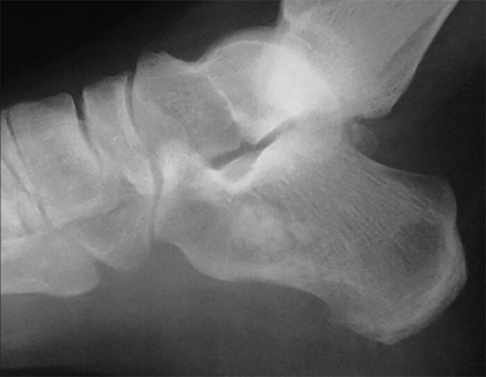Figura 5. Radiografía lateral del calcáneo a las 12 semanas del post operatorio.