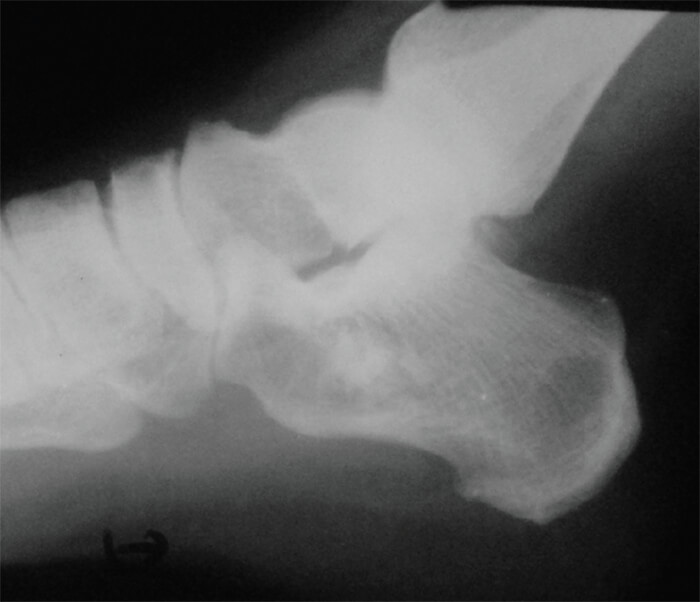 Figura 6. Radiografía lateral del calcáneo a 1 año del post operatorio.