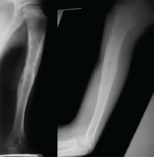 Figura 1. Radiografía panorámica anteroposterior y lateral del húmero al momento de la consulta inicial.