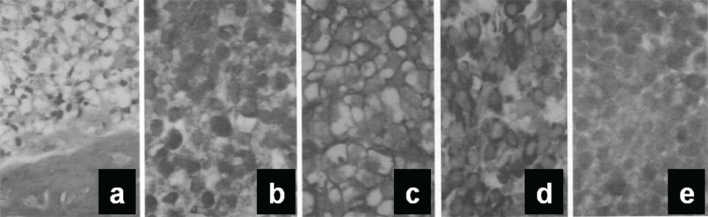 Figura 3. Imágenes de histopatología e inmunohistoquímica: H&E (a), EMA (b), CD99 (c), VIM (d) y SINAPTO (e).