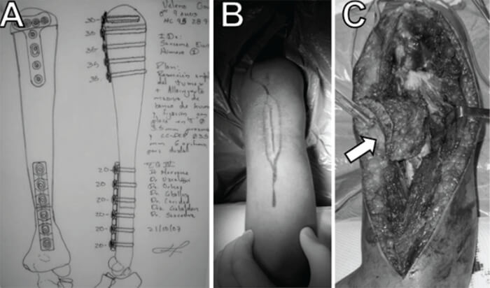 Figura 4. Imagen de la planificación preoperatoria (A), de la incisión con inclusión de la cicatriz de la biopsia abierta (B) e imagen intraoperatoria de la diáfisis una vez disecada (C) se observa la inclusión de la piel en torno a la cicatriz y tejidos blandos.