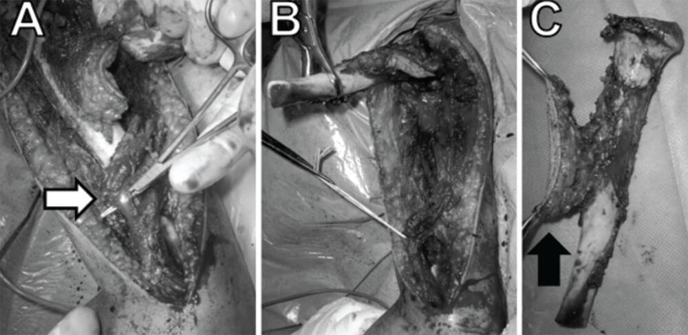 Figura 5. Fotografía del intraoperatorio (A) donde se señala al nervio radial, el cual fue preservado (Flecha blanca); de la diáfisis del húmero al realizar su resección (B); y de la pieza resecada (C) con las partes blandas circundantes a la lesión y al trayecto de la biopsia abierta (Flecha negra).