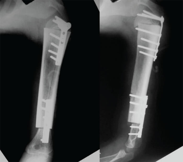 Figura 6. Radiografía del post operatorio inmediato en sus proyecciones anteroposterior y lateral.