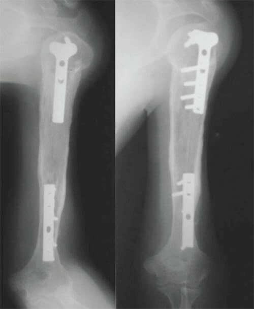 Figura 8. Radiografías del brazo en sus proyecciones anteroposterior y lateral a los 7 años del post operatorio.