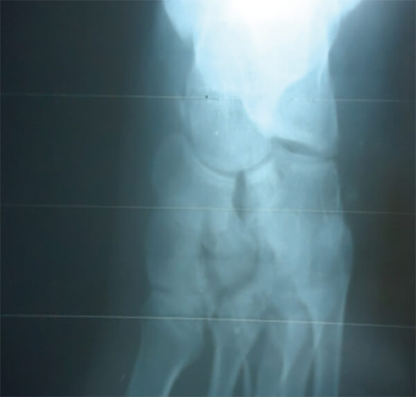Figura 1. Radiología Ap del pie izquierdo.