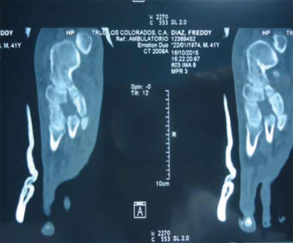 Figura 3. Tac de Pie izquierdo, donde se visualiza luxación plantar de la cuña intermedia.