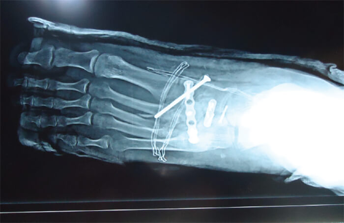 Figura 6. Radiología AP de pie izquierdo.
