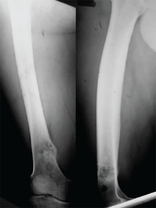 Figura 1. Radiografía en proyecciones anteroposterior y lateral al ingreso.