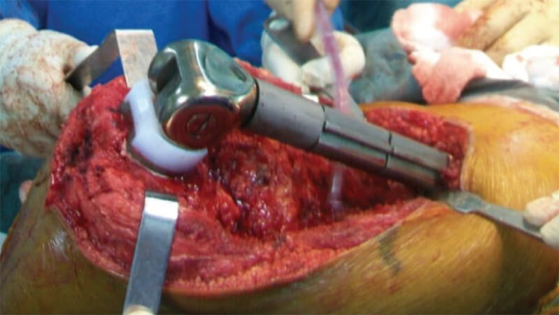 Figura 3. Imágenes del transoperatorio. La prótesis no convencional ya se ha colocado y se prueba la flexión máxima.