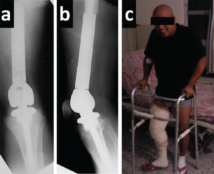 Figura 4. Radiografías anteroposterior (a) y lateral (b) post operatorias. Foto clínica del inicio de la bipedestación.